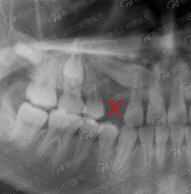 乳牙早失，恒牙失去引导导致萌出方向异常.jpg