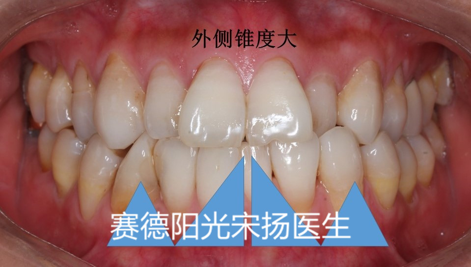 尊龙凯时阳光口腔宋扬医生牙齿黑三角科普图片