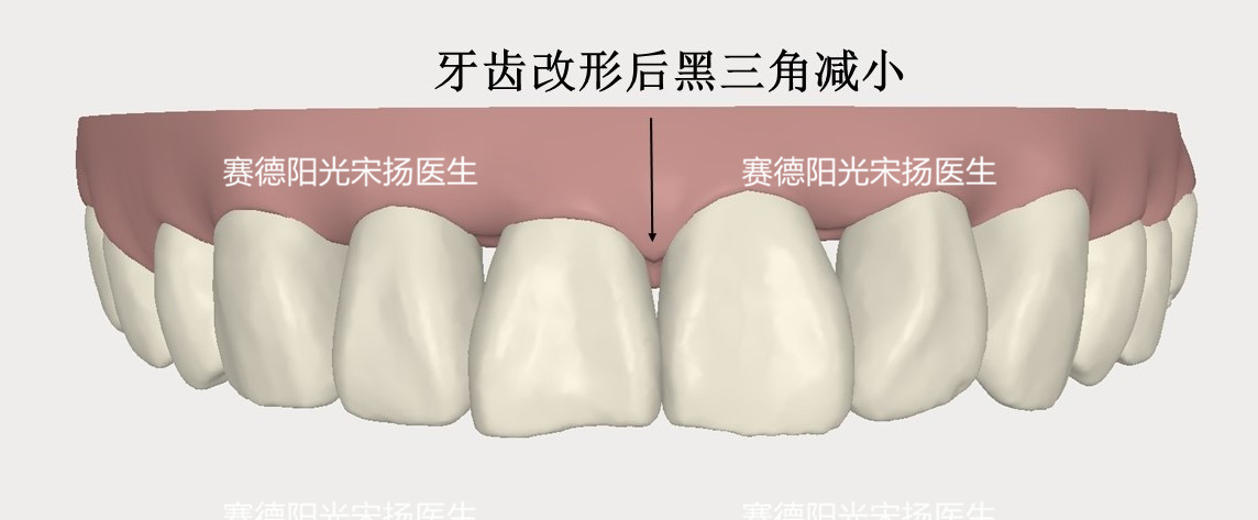 尊龙凯时阳光口腔宋扬医生牙齿黑三角科普图片