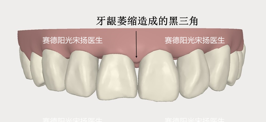 尊龙凯时阳光口腔宋扬医生牙齿黑三角科普图片