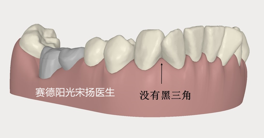 尊龙凯时阳光口腔宋扬医生牙齿黑三角科普图片