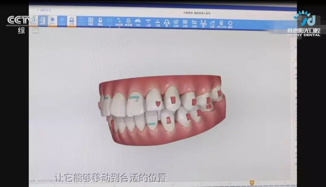 矫正器的准确度和效果也就可想而知