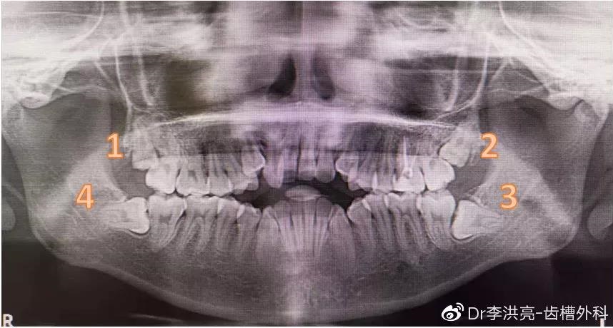 这位小伙伴可以说是很幸运（dao mei）地集齐了各种姿势的智齿