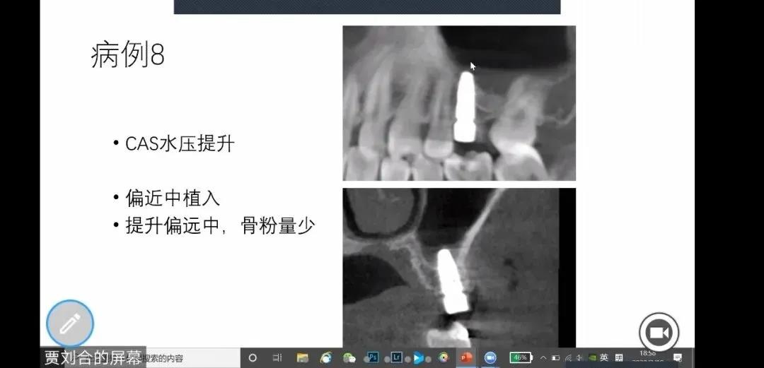 不断学习 共同进步  尊龙凯时阳光口腔举行种植研讨会