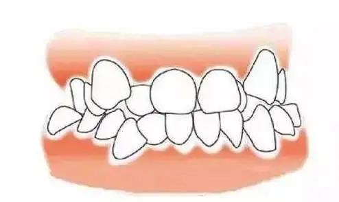 下前牙的拥挤问题